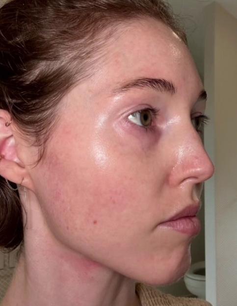 Collage of a woman's before-and-after facial comparisons and a video of her giving Volufiline reviews.