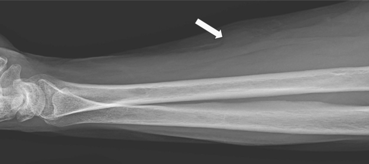 X-ray image showing thickening of the periosteum of the ulna as indicated by the white arrow.