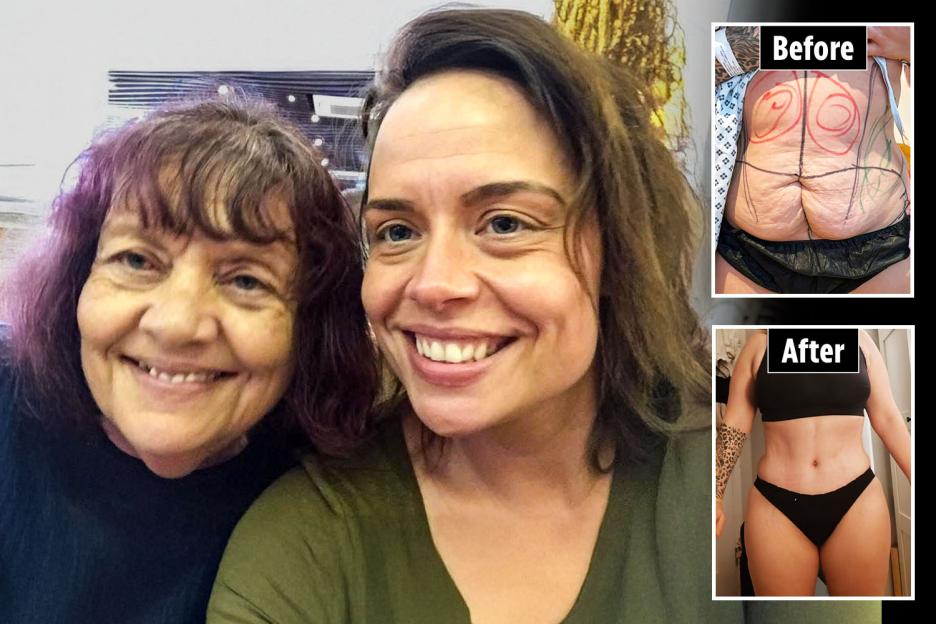 'Donating a Kidney to My Mom Was Worth It, But After Three Kids, My Tummy Needed a Makeover – Here’s How It Changed My Life!'