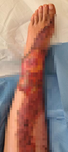 Severe burns covering Annie Perez's lower leg and foot.