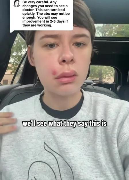 Woman with an infected red spot on her upper lip with a warning comment overlaid on the image.