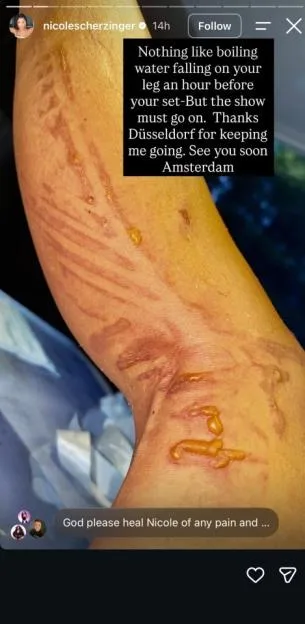 Nicole Scherzinger's leg with severe burns and blisters.