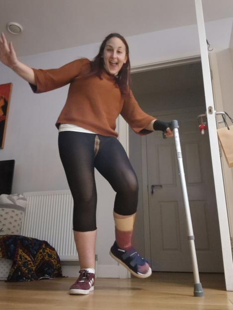 Annie Perez, 38, with a walking stick after suffering severe burns from an epileptic seizure.