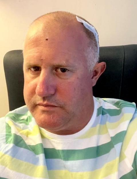 Man with a brain tumor, showing a bandage on his head.