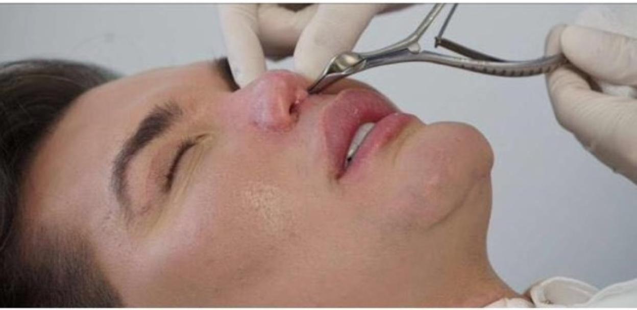 Rodrigo Alves having his seventh nose job.