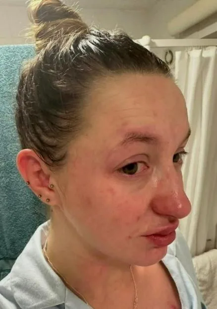 Hayleigh Allsopp showing injuries to her face, neck, and chest from an assault by her ex-partner.