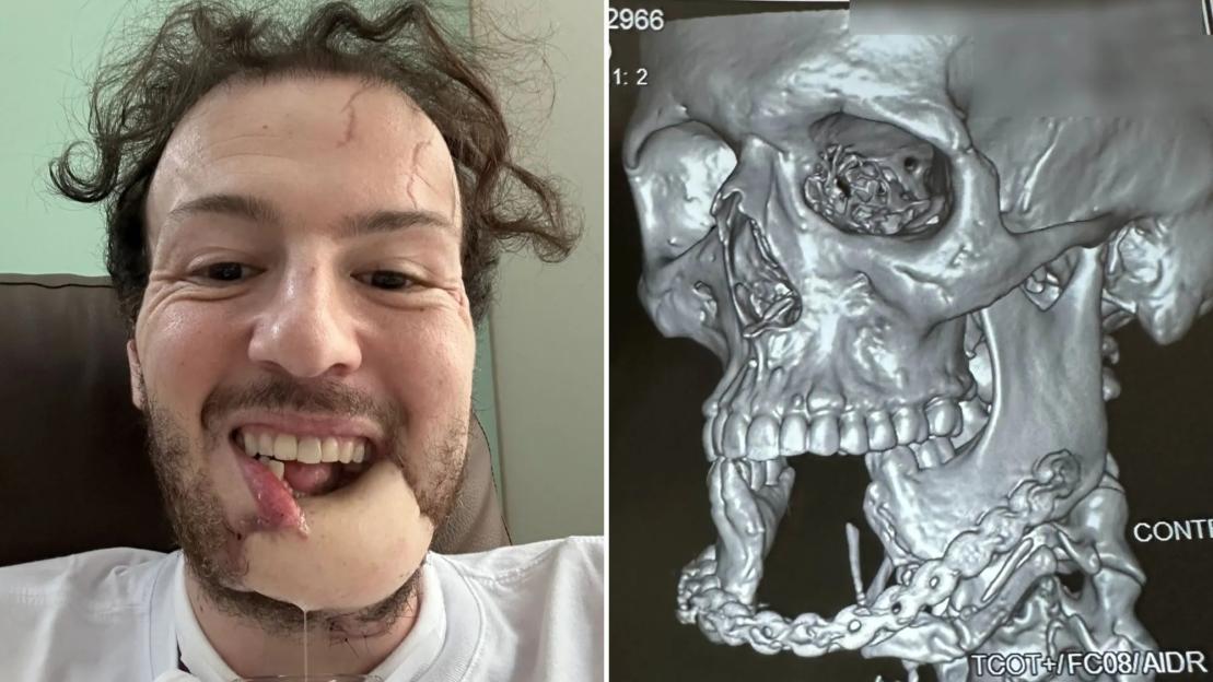 Man Suffers Severe Facial Injuries After Collision with Metal Bar While Pursuing Phone Thief