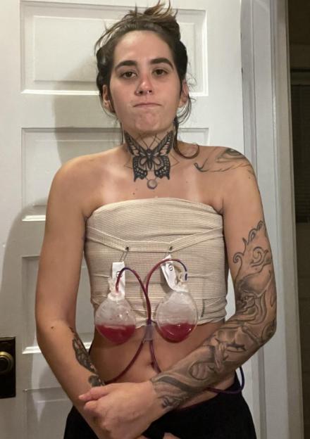 A person with a butterfly tattoo on their neck stands with two fluid drainage bulbs attached to their chest.