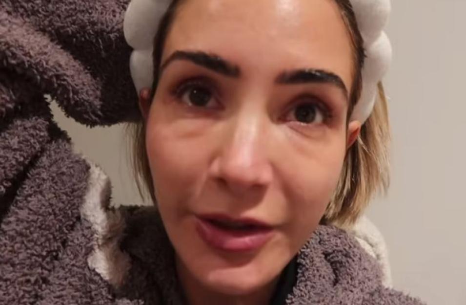 Frankie Bridge's swollen and bruised face after a cosmetic treatment.