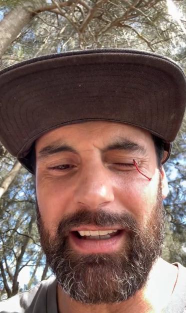 MAFS Star Suffers Shocking Injury After Fish Hook Gets Stuck in His Eye