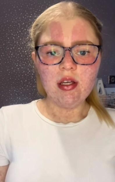 A woman with a birthmark on her face, wearing glasses and a white shirt.