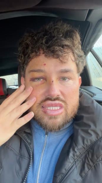 'Married At First Sight’s Mark Kiley Opens Up on Social Media with Shocking Photos of His Bruised Face After Violent Attack'