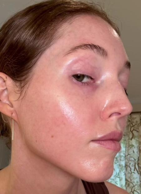 Collage of a woman's before-and-after facial comparisons and a video of her giving Volufiline reviews.