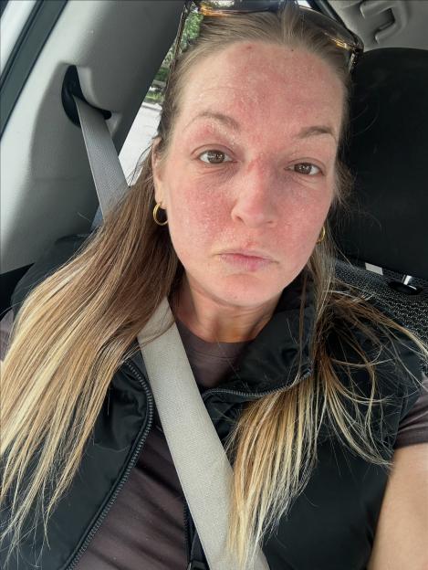 Sophie Purvis with red, flaky, and irritated skin on her face due to topical steroid withdrawal.