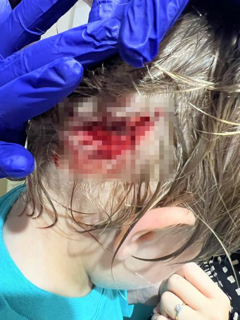 Head injuries sustained from a dog attack, shown on a child's head.