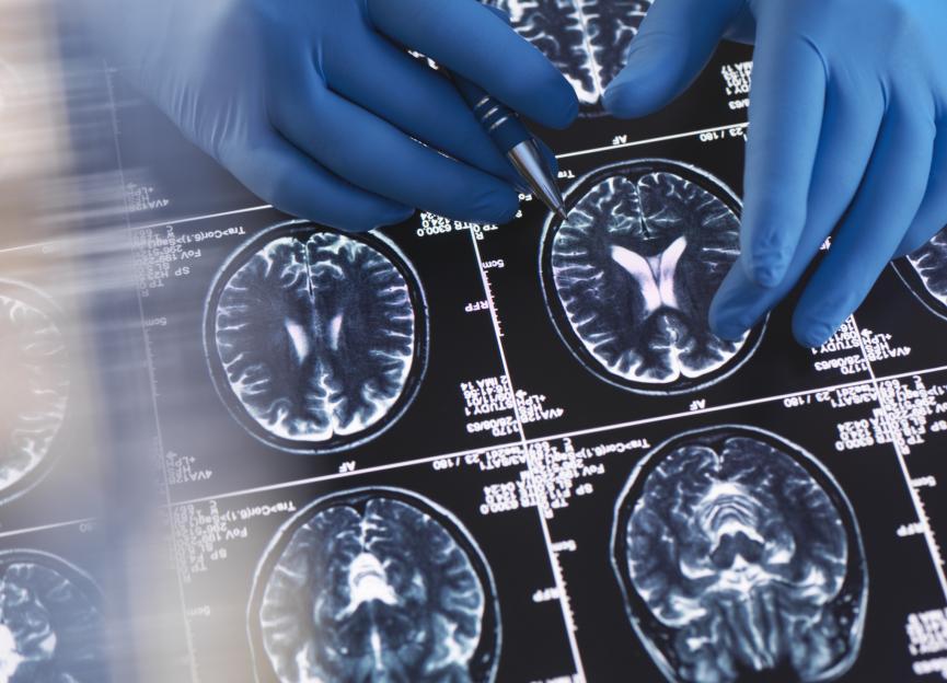 Doctor with gloved hands reviewing MRI brain scans.