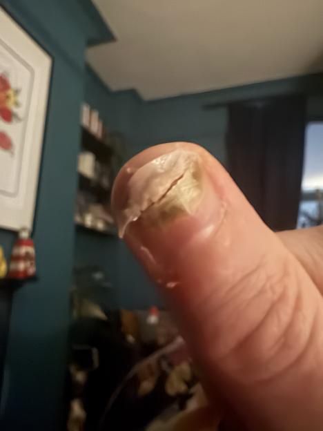 A person's thumb with a green, peeling, and blistered fingernail.