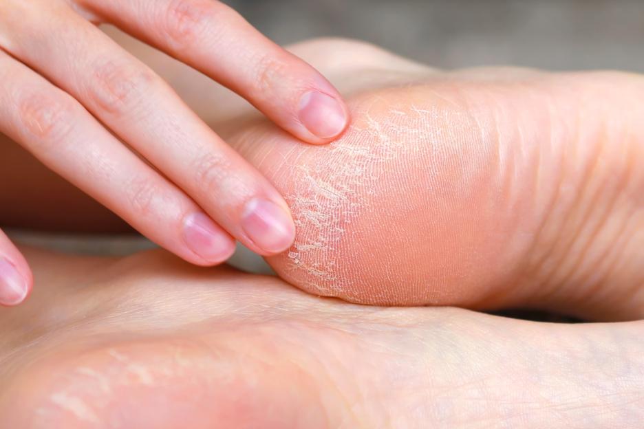 "I’m a Skincare Expert: 6 Essential Tips to Revive Dry, Cracked Feet This Summer!"