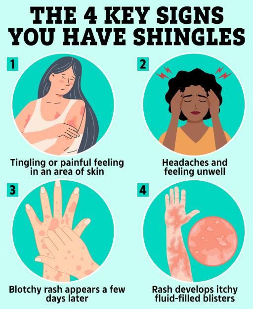 Illustration of the four key signs of shingles: tingling or painful skin, headaches and feeling unwell, a blotchy rash, and itchy fluid-filled blisters.