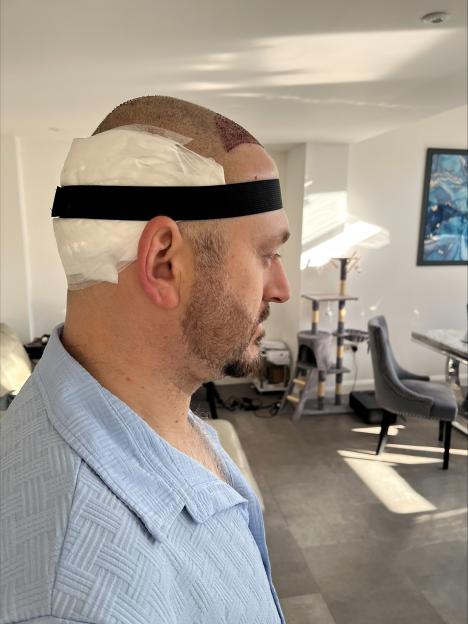Cornel after his first hair transplant surgery, with bandages on his head and a visible hairline.