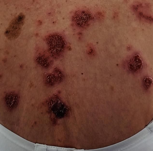 Skin complaint on a person's back.