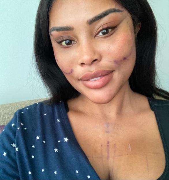 Woman with surgical markings on her face and chest.