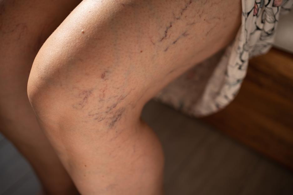 Broken capillaries