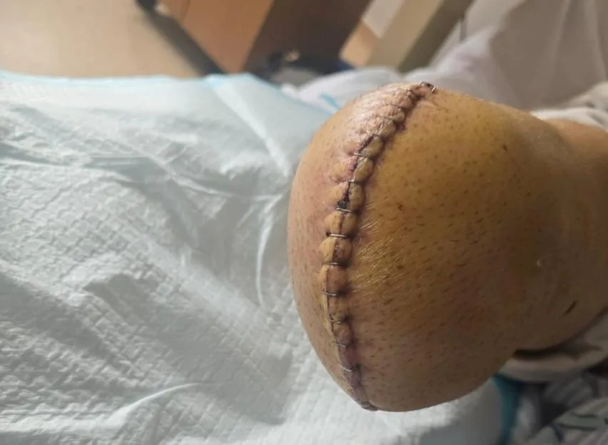 A surgical stump with staples along the incision following a leg amputation.