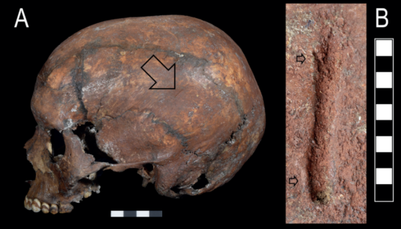 Collage of a human skull showing an injury and a close-up of a groove.