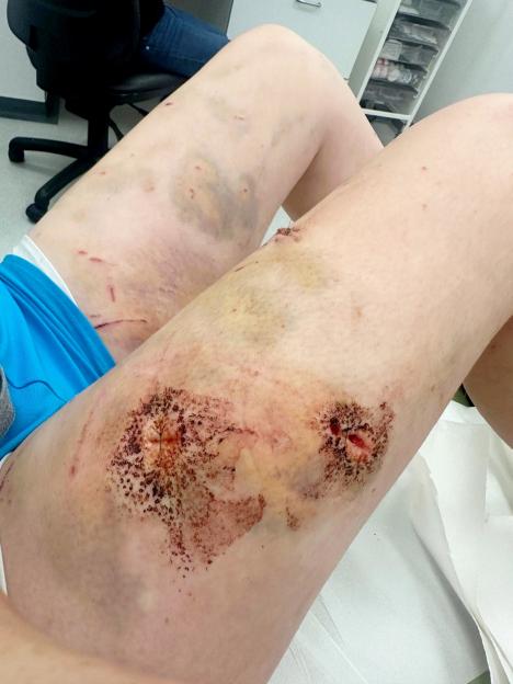 'I adopted a dog from Facebook - weeks later he attacked me and I needed surgery'