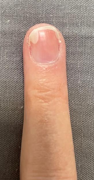 Finger with a white growth on the nail.