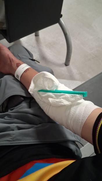 Freddy Brazier's bandaged arm after a dog attack.