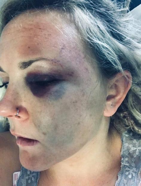 Lucy Winter, a victim of domestic abuse, with teary eyes, a cut on her lip, and blonde dreadlocks.