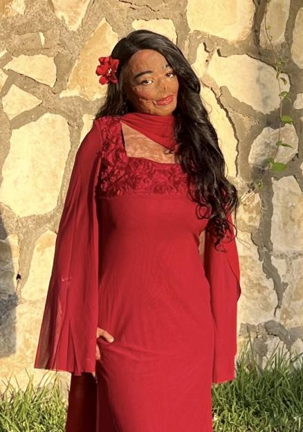 Schoolgirl, 12 left with horrific burns on half her body after shampoo catches fire