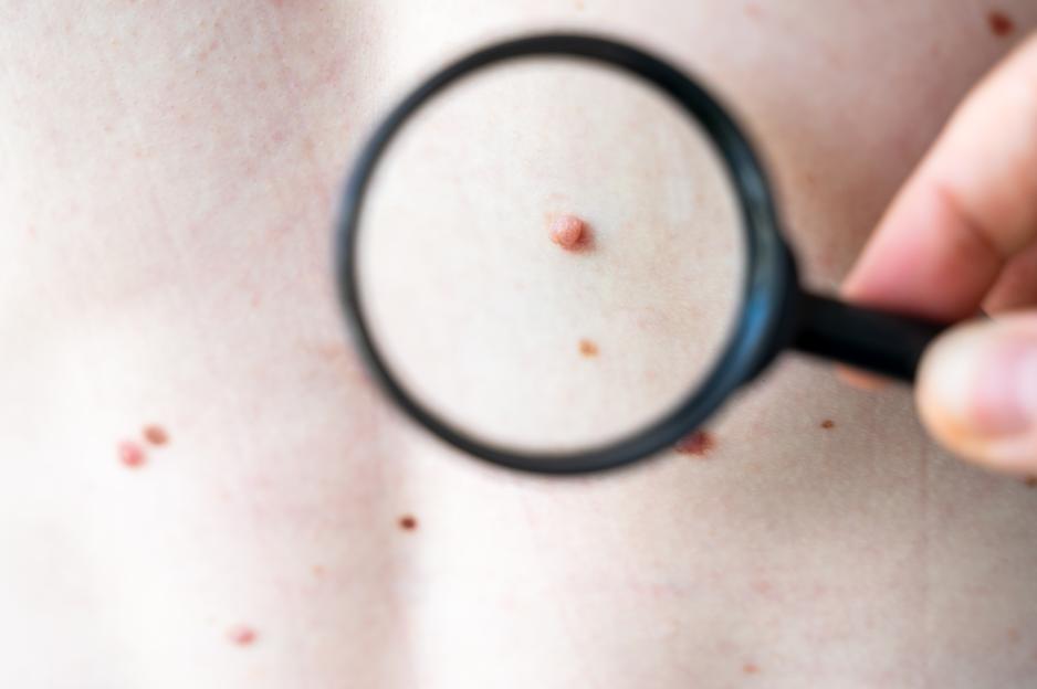 A skin mole under a magnifying glass during a dermatological checkup.