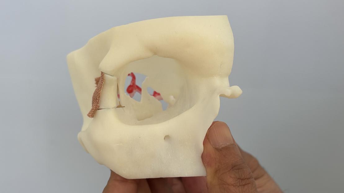 Keyhole brain aneurysm operation