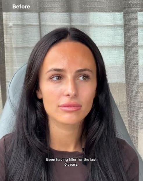 Woman with full lips before filler dissolution.