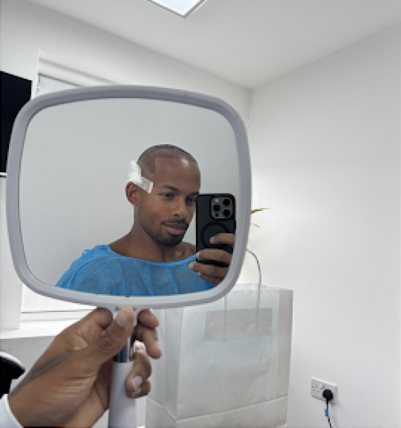 Man with receding hairline looking at himself in the mirror after a hair transplant.