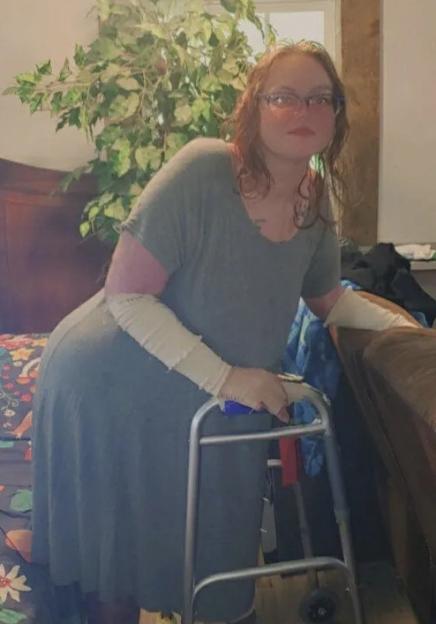 A woman with bandages on her arms leans on a walker.