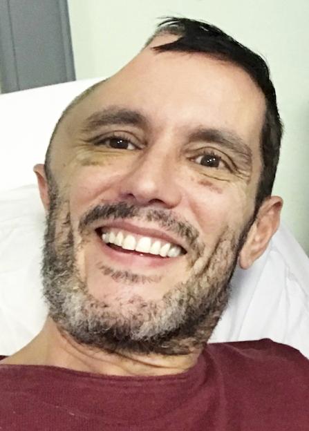 Alastair Wallace in a hospital bed with severe bruising around his eyes after his fall.