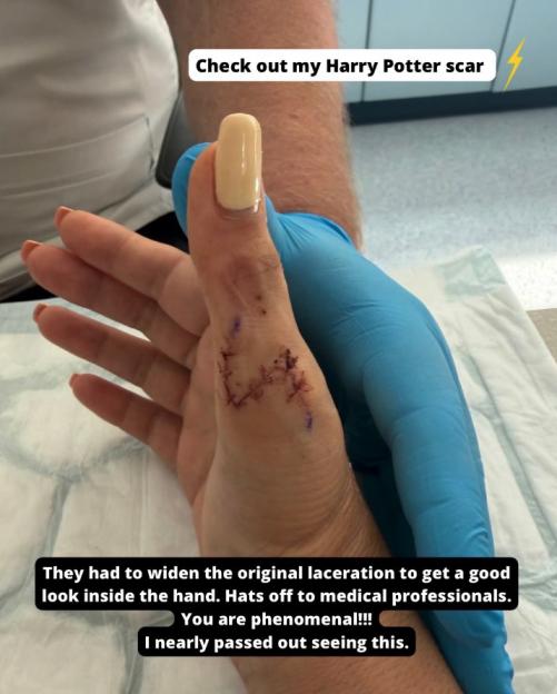 A person's hand with fresh stitches on the thumb and palm, held by a medical professional in a blue glove.