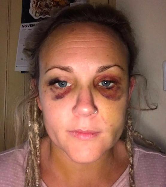 A close-up of Lucy Winter, 41, with severe bruising around both eyes.