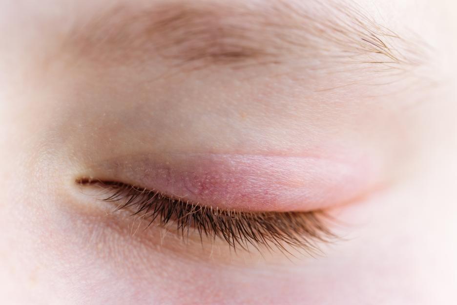 Closed eye of a child showing upper eyelid swelling and redness