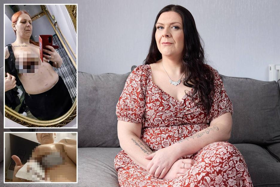 'How My Failed Breast Surgery in Turkey Cost UK Taxpayers Thousands and Left Me Unable to Work for Months'