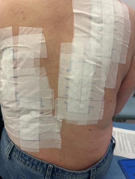 Patch testing on Sophie's back.