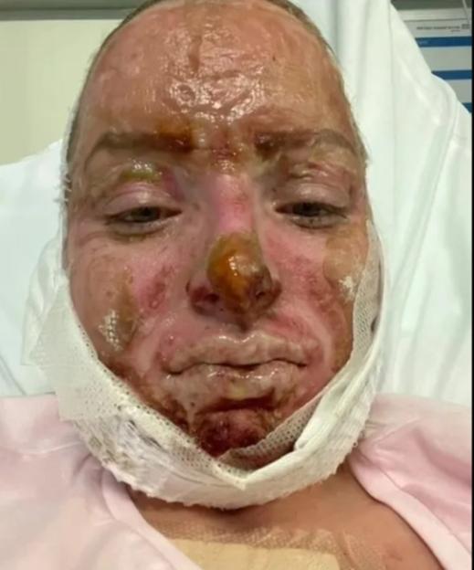 A woman with severe facial burns lies in a hospital bed with a bandage under her chin.