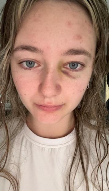 A young woman with a black eye.