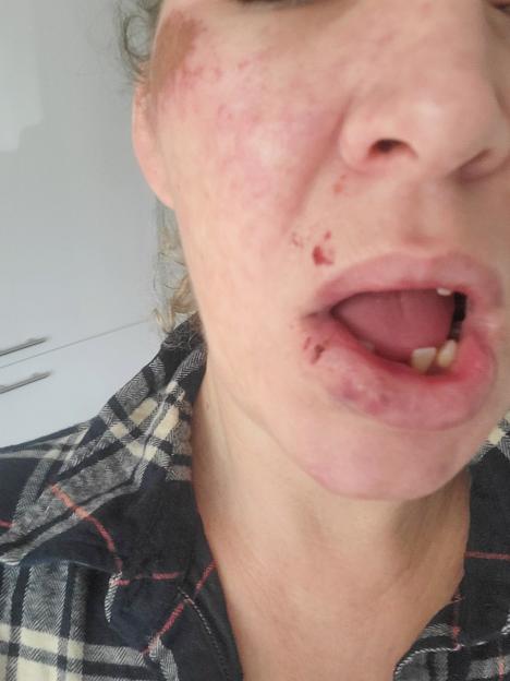 SNPothole- mother whose life has been changed forever after she tripped on a deep pothole said no one has taken responsibility