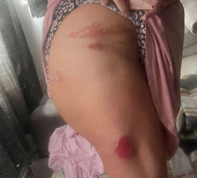 Injuries on Sarah Tragner's leg from boiling water and a hammer attack.