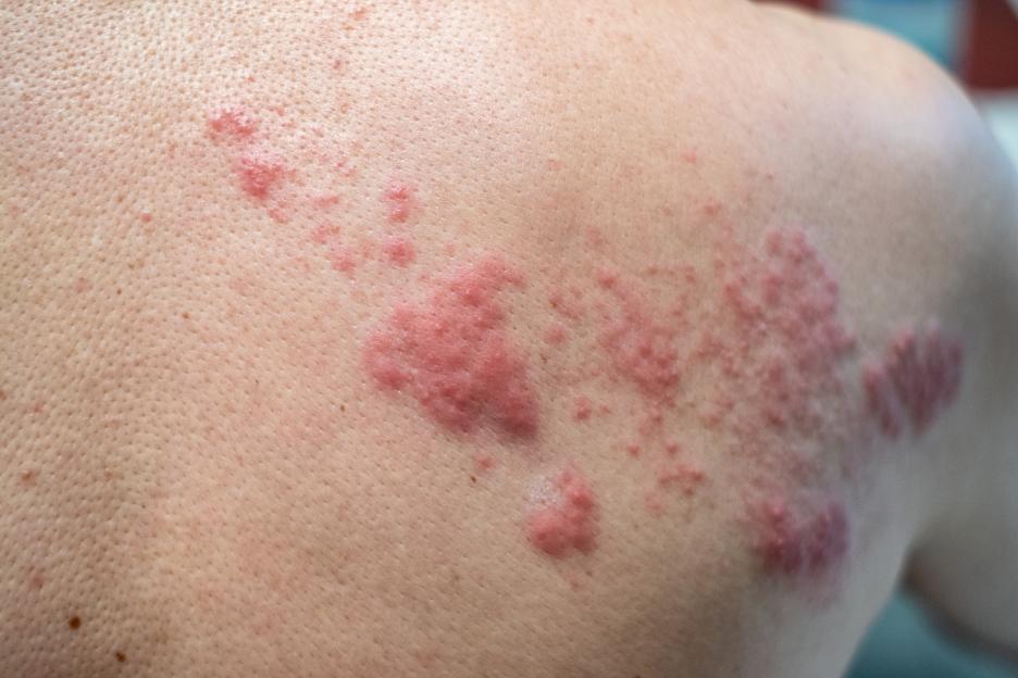 Urgent Alert: Rising Shingles Cases Among Young Women Could Lead to Nerve Damage – Know These 4 Warning Signs!